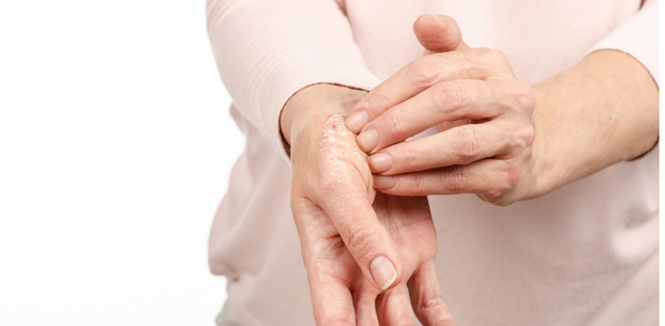 FDA Approves Bimzelx for Plaque Psoriasis: A New Hope for Patients as of October 17, 2023